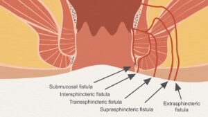fistulas- described by graphics