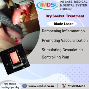 Dental DIODE LASER for Dry Socket