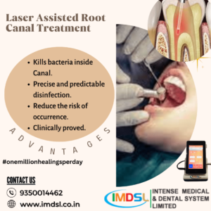Dental Diode Lasers for RCT