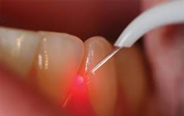 Why You Should Choose a Laser Dentist for Gum Disease Treatment