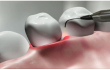 Why Dental Laser Treatment should be used