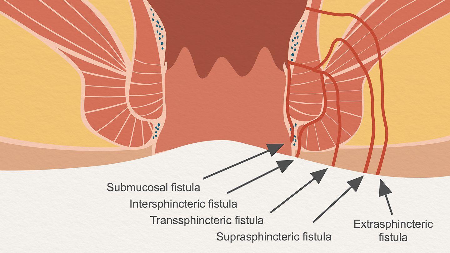 Laser in case of Fistula in ANO- Use of Proctology Laser