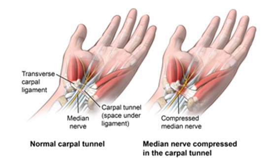 Carpal Tunnel Syndrome Treatment by Low-Level Physiotherapy Laser